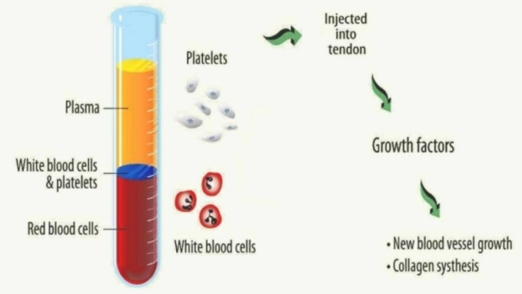  부산 정형/재활 지속되는 강한 통증 PRP(자가혈소판풍부혈장술)주사