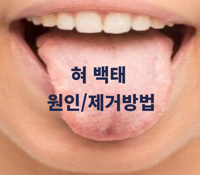  혀 백태 원인과 제거 방법 알아보기