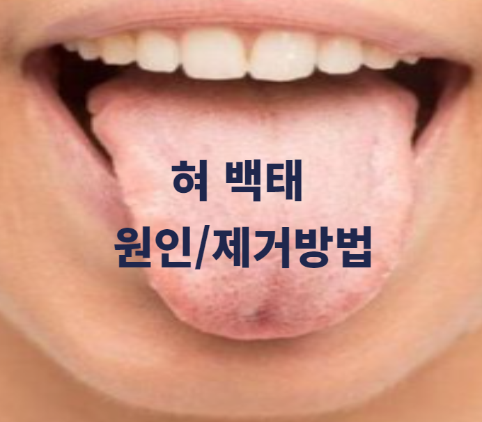 혀 백태 원인과 제거 방법 알아보기