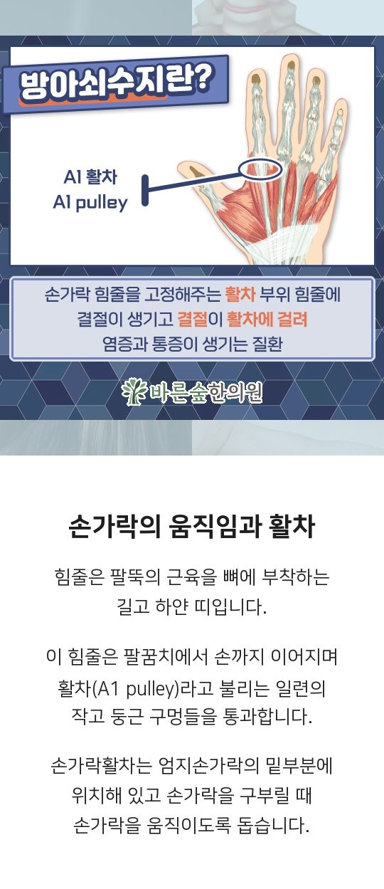 방아쇠수지증후군,손가락부정,대구동구방촌한의원 바른숲한의원 2