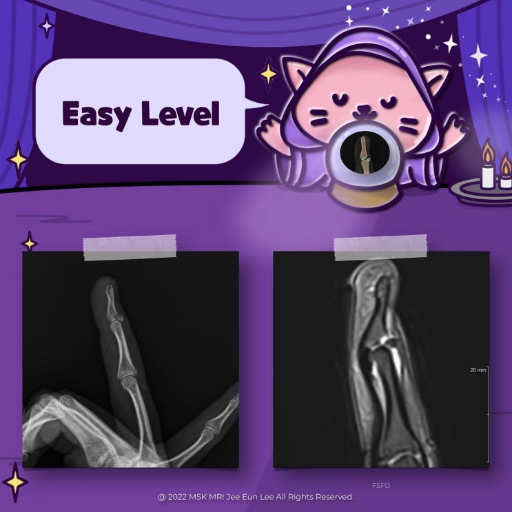  [Wrist/Finger_Case_#01] [Easy level] Mallet Fracture
