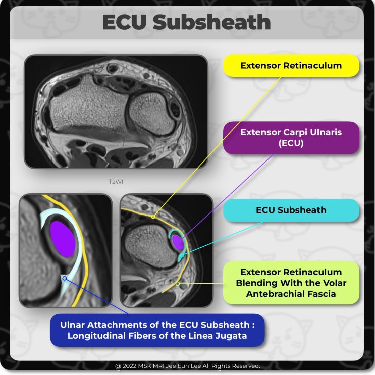  [Anatomy_20] Extensor carpi ulnaris (ECU) subsheath complex, Linea Jugata