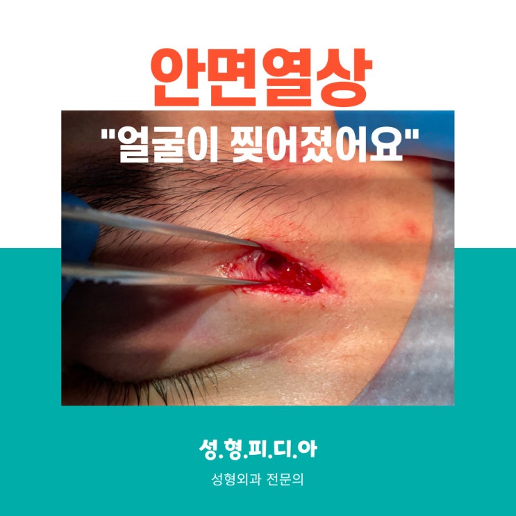  [안면열상] 얼굴이 찢어졌어요.