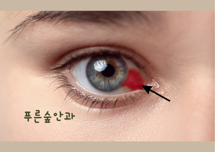 결막에 빨간 점이 있어요! 결막하출혈인가요?