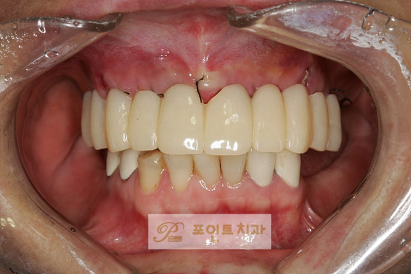  [탕정치과] 자녀분 결혼식을 앞두고... : 전악수복 / 천안 아산