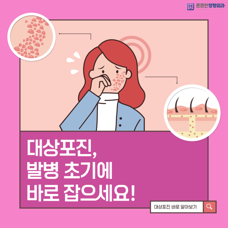 진주 대상포진의 원인과 치료 방법은?