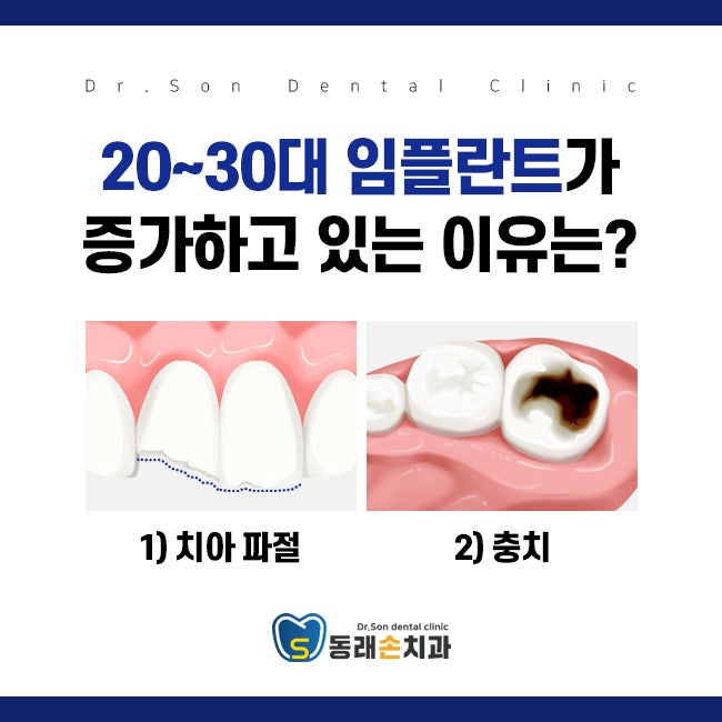 동래치과 앞니임플란트시, 치과 선택이 중요한 이유