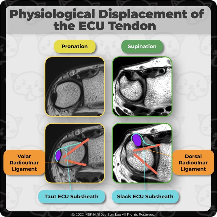  [Anatomy_21] Physiologic displacement of the extensor carpi ulnaris Tendon, Pronation, Supination