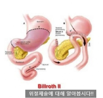 (수술공부)GS:Gastrectomy #2 subtotal:billroth2(위절제술)