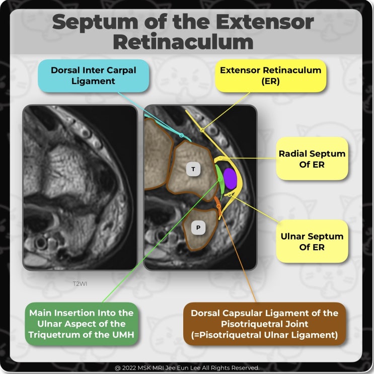  [Anatomy_22] Septum of the Extensor Retinaculum, wrist MRI