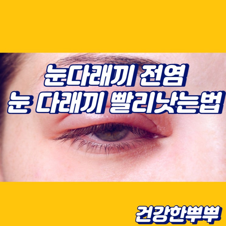  눈다래끼전염 눈다래끼원인 눈다래끼빨리낫는법