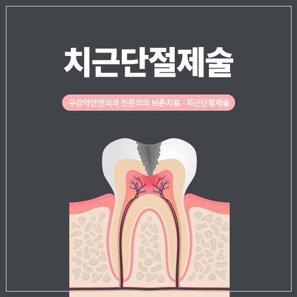 신경치료 후 통증: 정단절제술