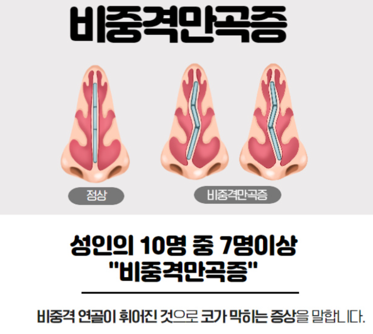  비중격 만곡증(Septal deviation, Deviated nasal septum) (1) - 비중격의 구조, 정의, 원인, 분류, 증상, 진단
