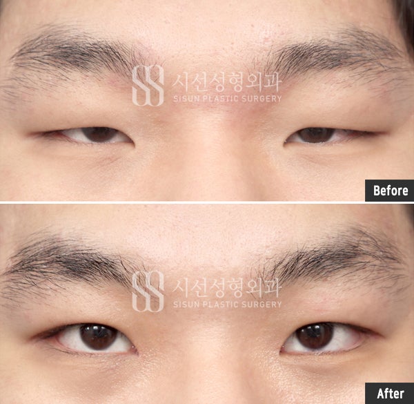 남자 안검하수(눈꺼풀 처짐)증상에 대해(원인, 증상, 치료법, 수술방식)