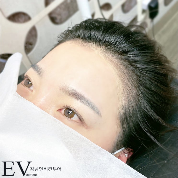  강남역헤어라인 시술은 어떤건지 알아보자