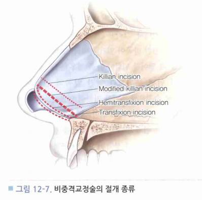 비중격 만곡증(Septal deviation, Deviated nasal septum) (2) - 비중격 교정술, 비중격 성형술 ...
