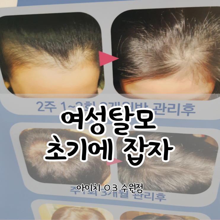  여성탈모 초기 잡기 수원탈모관리 아미치0.3수원점