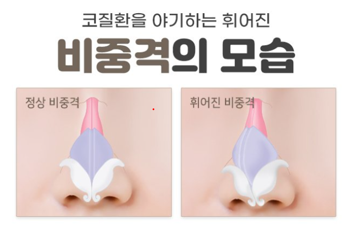  비중격 만곡증(Septal deviation, Deviated nasal septum) (2) - 비중격 교정술, 비중격 성형술(Septoplasty)