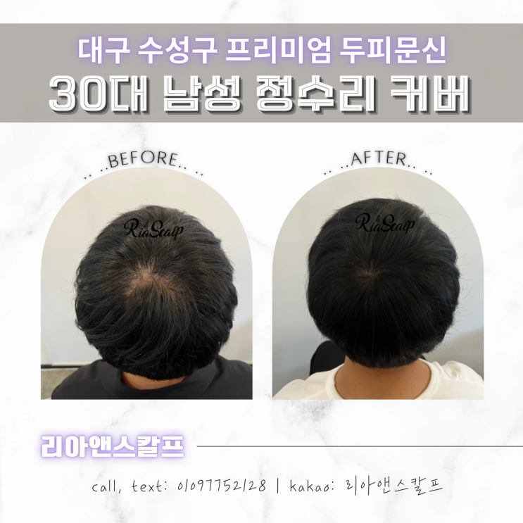  대구 두피문신 잘하는 곳에서 알려주는 SMP두피문신 음주