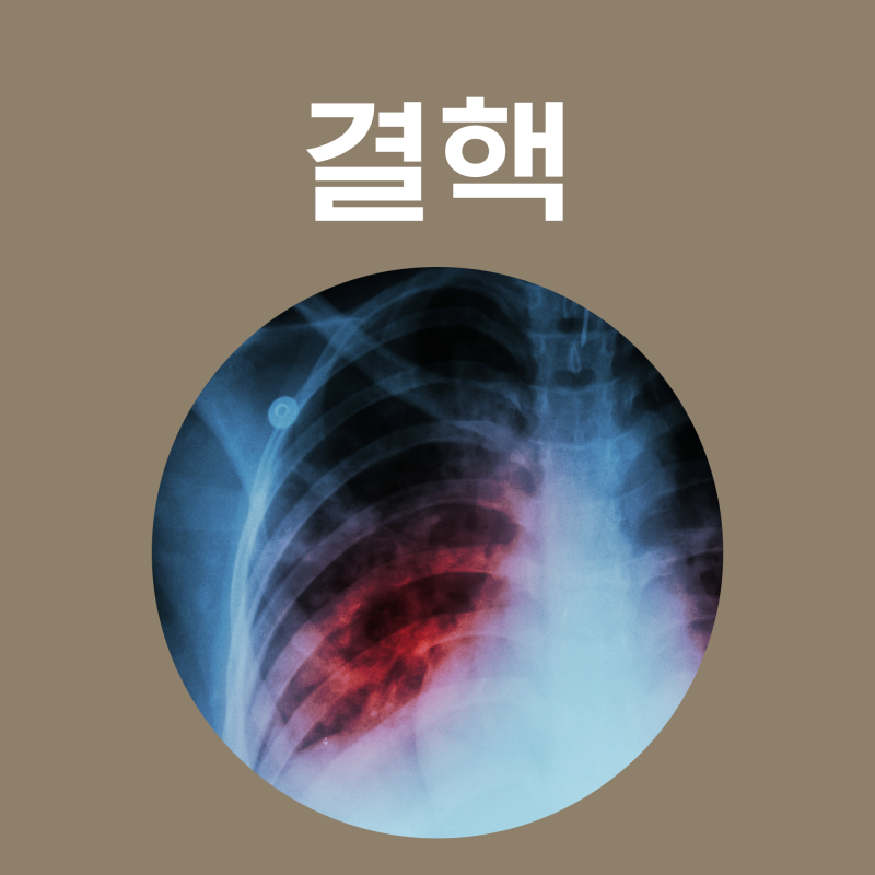 결핵 종류 증상 초기증상 검사 치료 약 잠복 폐결핵 BCG 예방 접종 전염 전염성 백신 척추 좁쌀 신장 : 네이버 블로그