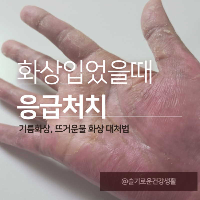 1도 2도 3도 화상입었을때 화상응급처치 (기름, 뜨거운물, 심재성2도화상) : 네이버 블로그