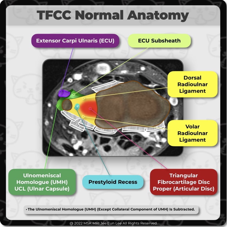  [Anatomy_23] Triangular fibrocartilage complex (TFCC), wrist MRI