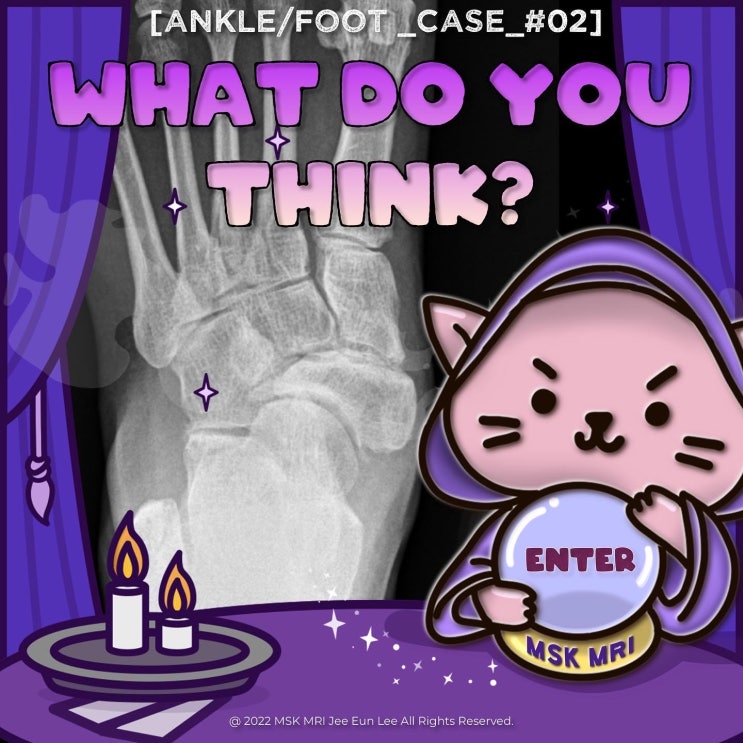  [Ankle/foot_Case_#02] [Challenging level] Mueller-Weiss syndrome
