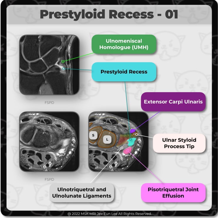  [Anatomy_25] Prestyloid Recess, ulnotriquetral ligament, Ulnomeniscal Homologue -01