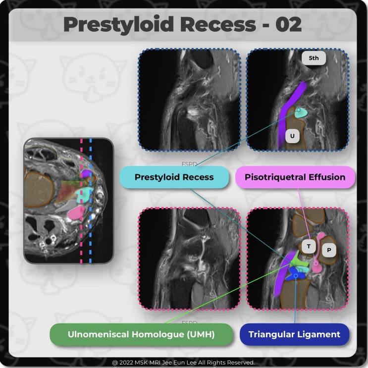 [Anatomy_26] Prestyloid Recess, ulnotriquetral ligament, Ulnomeniscal Homologue -02