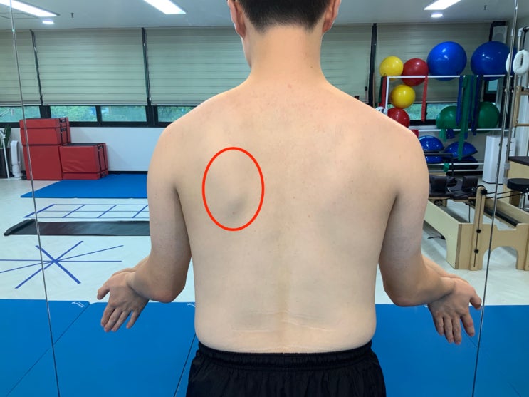인천체형교정 / 견갑골 불안정성 개선을 위한 운동프로그램 인천체형교정 / 견갑골 불안정성 개선을 위한 운동프로그램