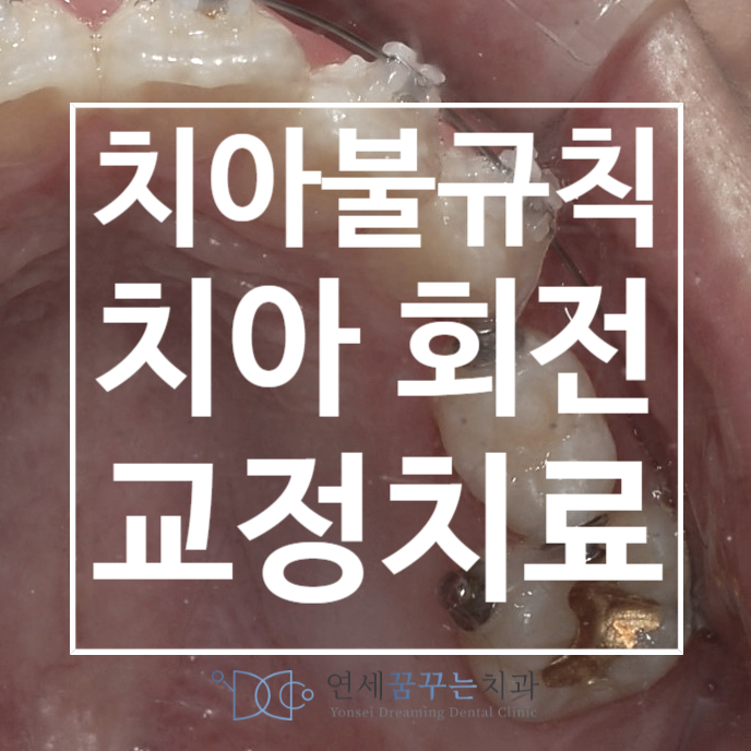 작은 어금니가 회전된 경우 + 치아가 틀어진 경우 교정치료, 강일에서 청소년 교정을 선택할 때!