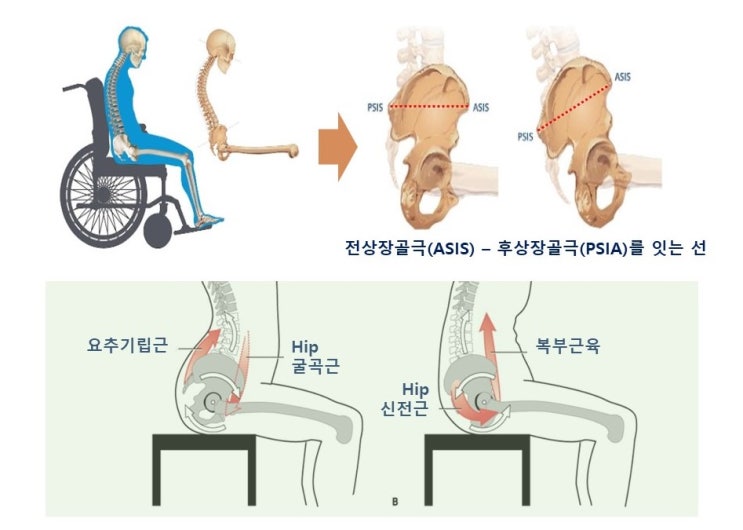  골반 후방경사(pelvic posterior tilt)와 푹신한 소파,  골반기저근, 고관절 통증, 천장관절증후군, 심박변이도