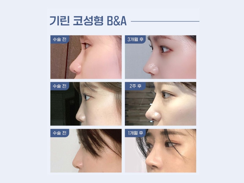 비염코수술 코막힘 문제 살펴보고
