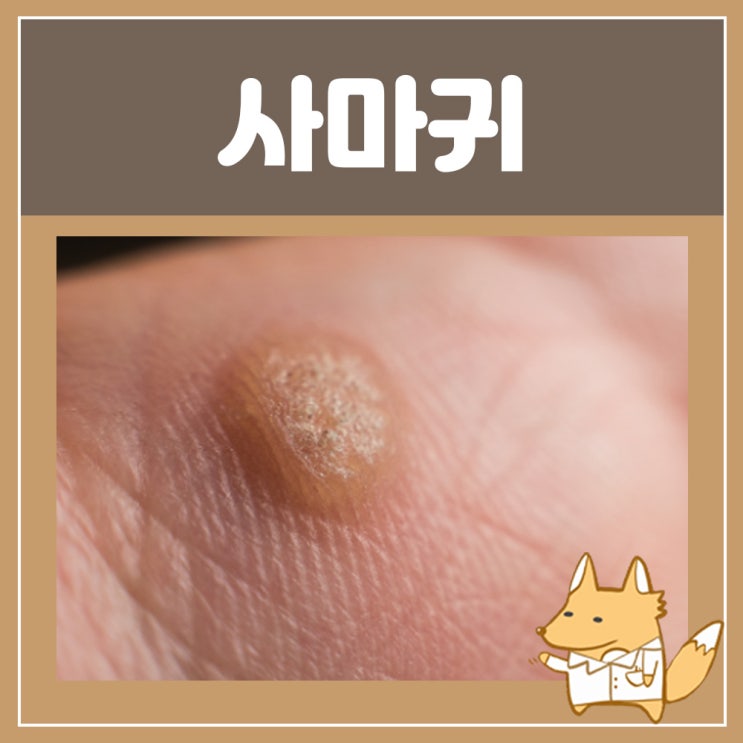  발바닥 사마귀 제거 원인 연고 : 생율무가루 율무 사마귀 레이저 치료
