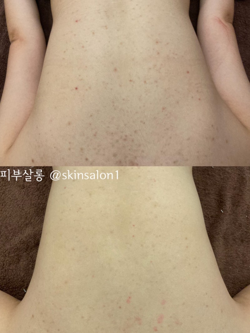 대구피부관리실)달서구 알라딘필링팔여드름자국재생케어리뷰/죽전동피부관리실 8