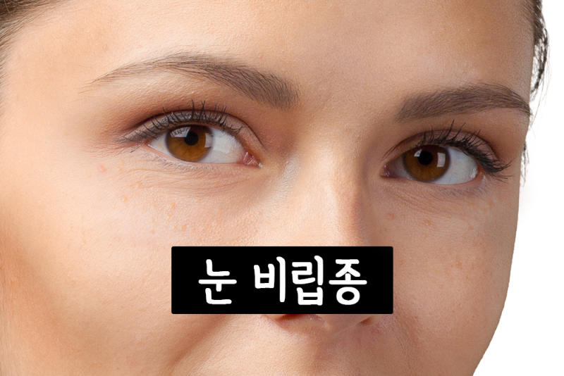 눈 비립종 제거 관리