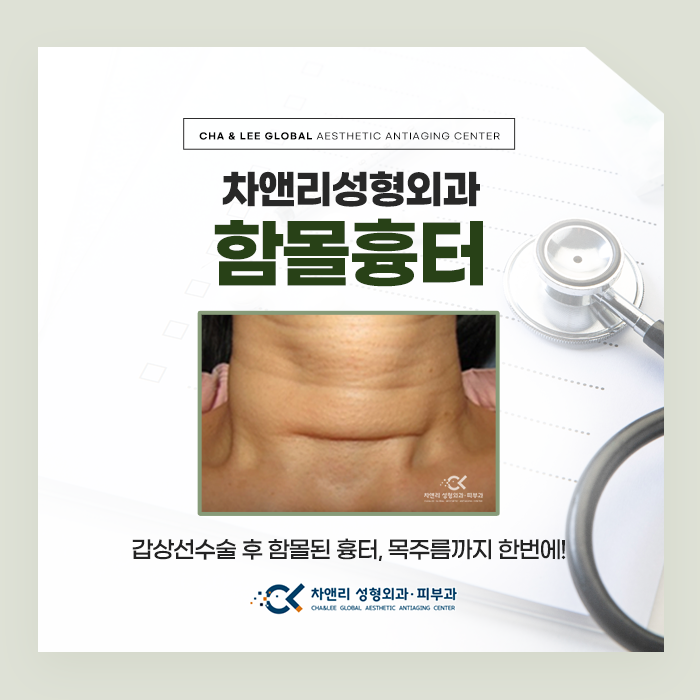  갑상선수술 후 생긴 함몰흉터 고민된다면