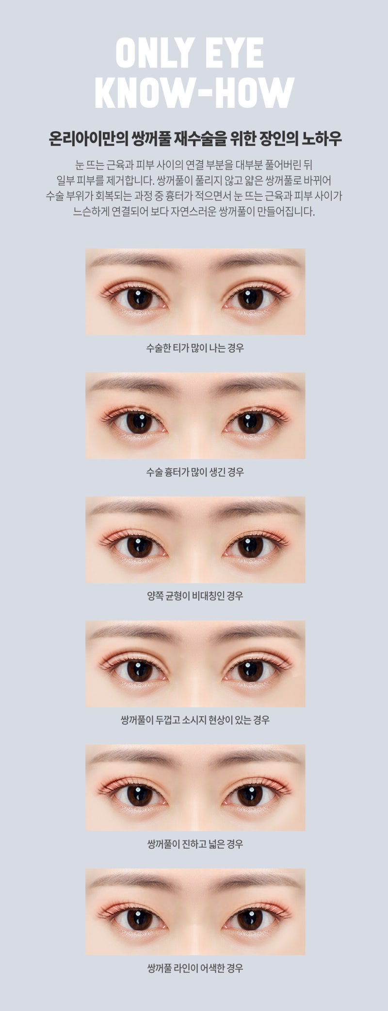 ●쌍꺼풀 재수술을 잘하는 병원시스템과 경험이 중요
