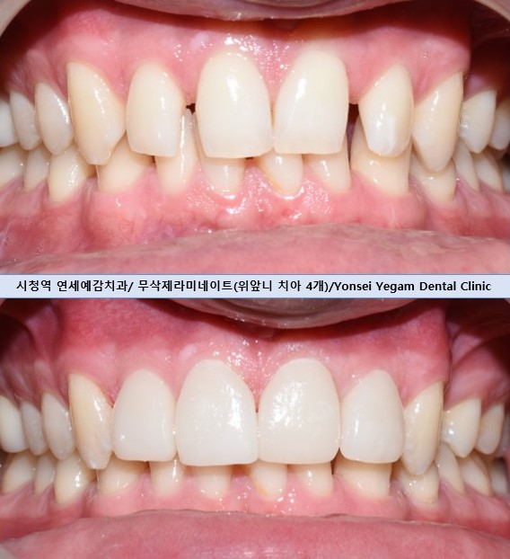  [시청역/광화문] 왜소치, 삐뚤고 벌어진 앞니 라미네이트 케이스 안내