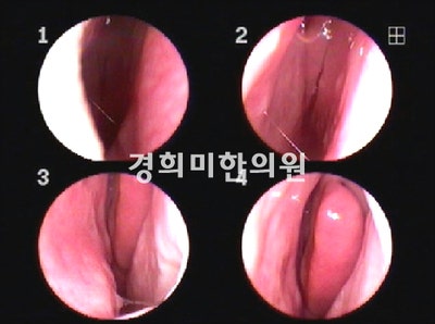알레르기 비염, 축농증(부비강염)의 증상과 원인 치료 / 재채기, 콧물, 코막힘, 후비루, 후각 상실 4