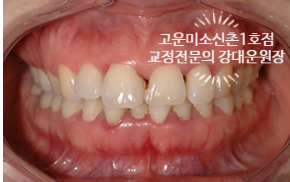  재교정치료 - 고운미소치과신촌1호점