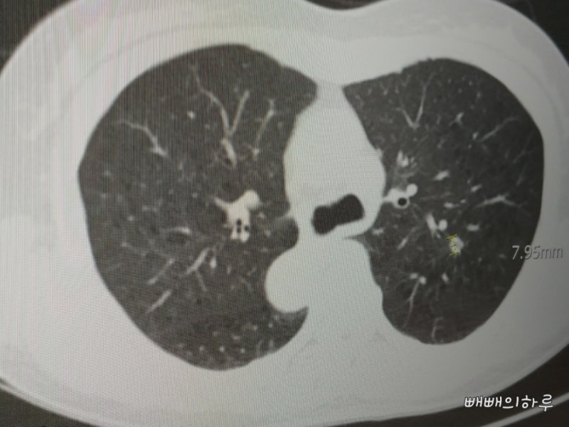 한일병원 폐ct저선량 폐암 의심 문자 폐암검진 금연 결절8mm 호흡기내과 : 네이버 블로그