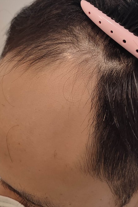 보정동미용실 M자탈모 잔머리펌 랑스헤어 : 네이버 블로그 보정동미용실 M자탈모 잔머리펌 랑스헤어 : 네이버 블로그