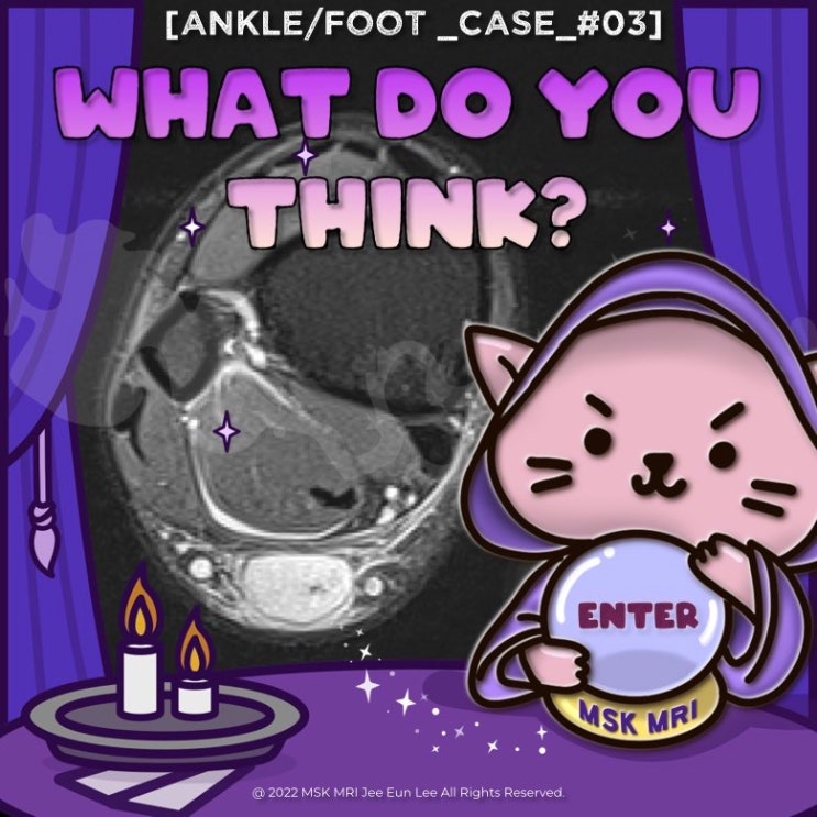  [Ankle/foot_Case_#03] [Easy level] Achilles tendon complete rupture, Typical case
