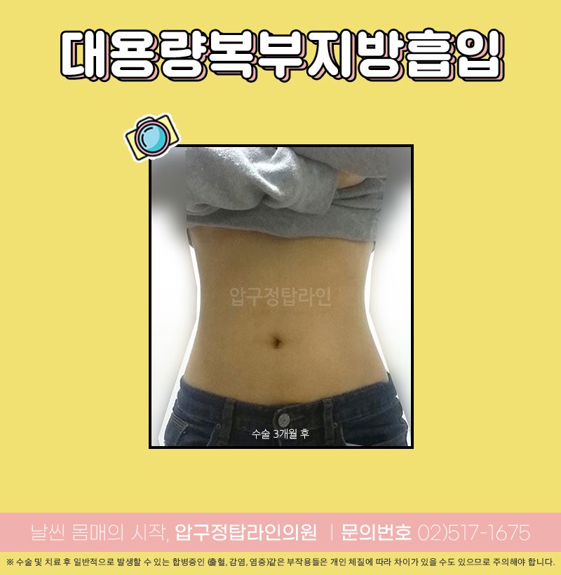 복부 뱃살 다이어트 방법! (상체지방흡입후기)