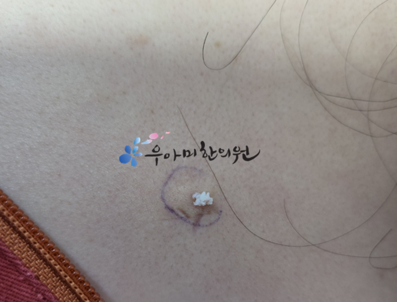 회음부 종기 대처 방안 (바톨린낭종 제거에 대한 새로운 시각)