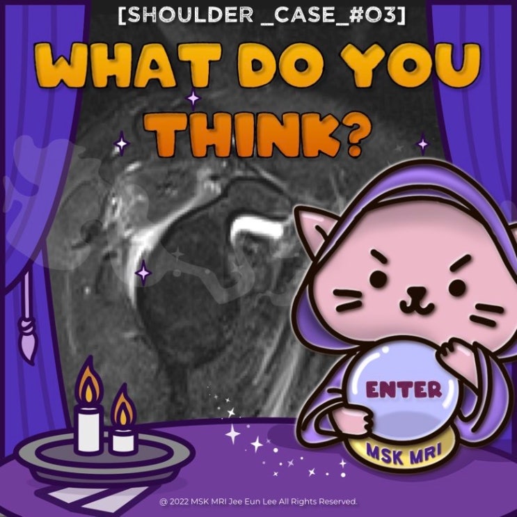  [Shoulder_Case_#03] [Challenging level] Acute calcific periarthritis