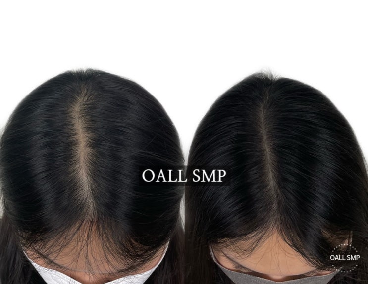  [OALL Scalp studio] 여자탈모, 가르마탈모 밀도보완 두피smp