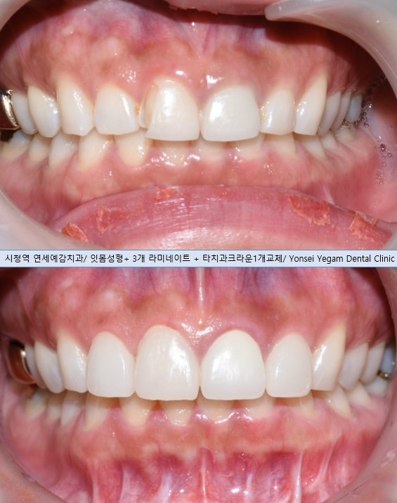 VENEER in Seoul, Korea/ Cost, Cases(before&after photos)/ YONSEI YEGAM DENTAL CLINIC