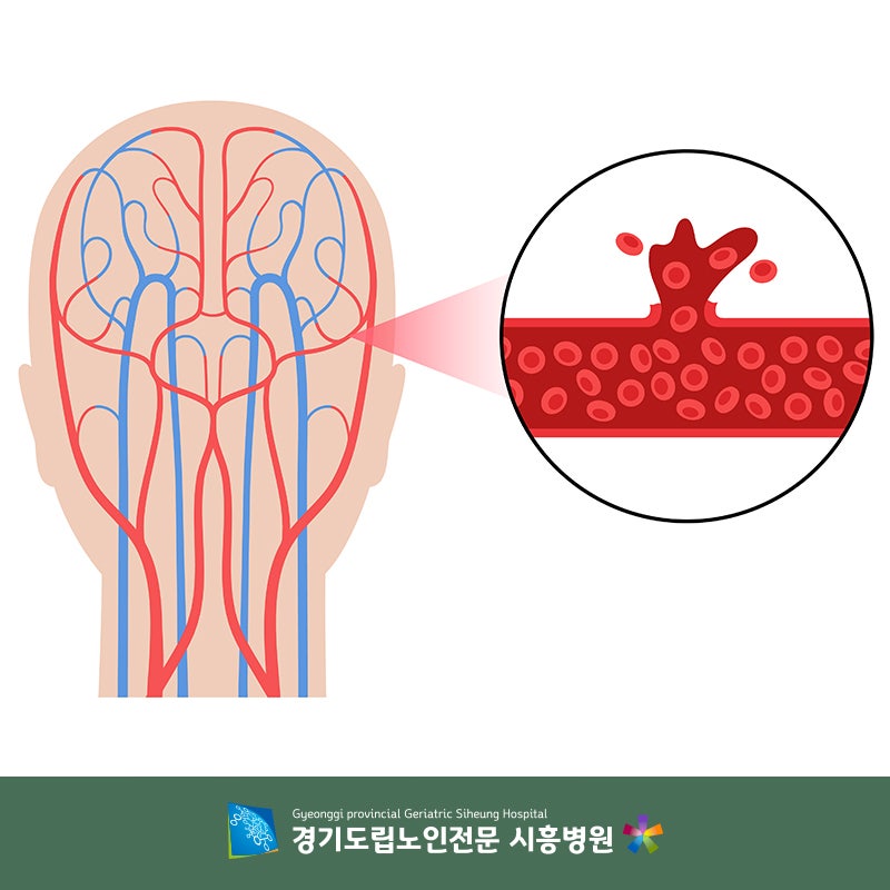 심혈관 및 뇌혈관 질환의 전구 증상에 대한 종합적인 요약은 FAST만 기억합니다!